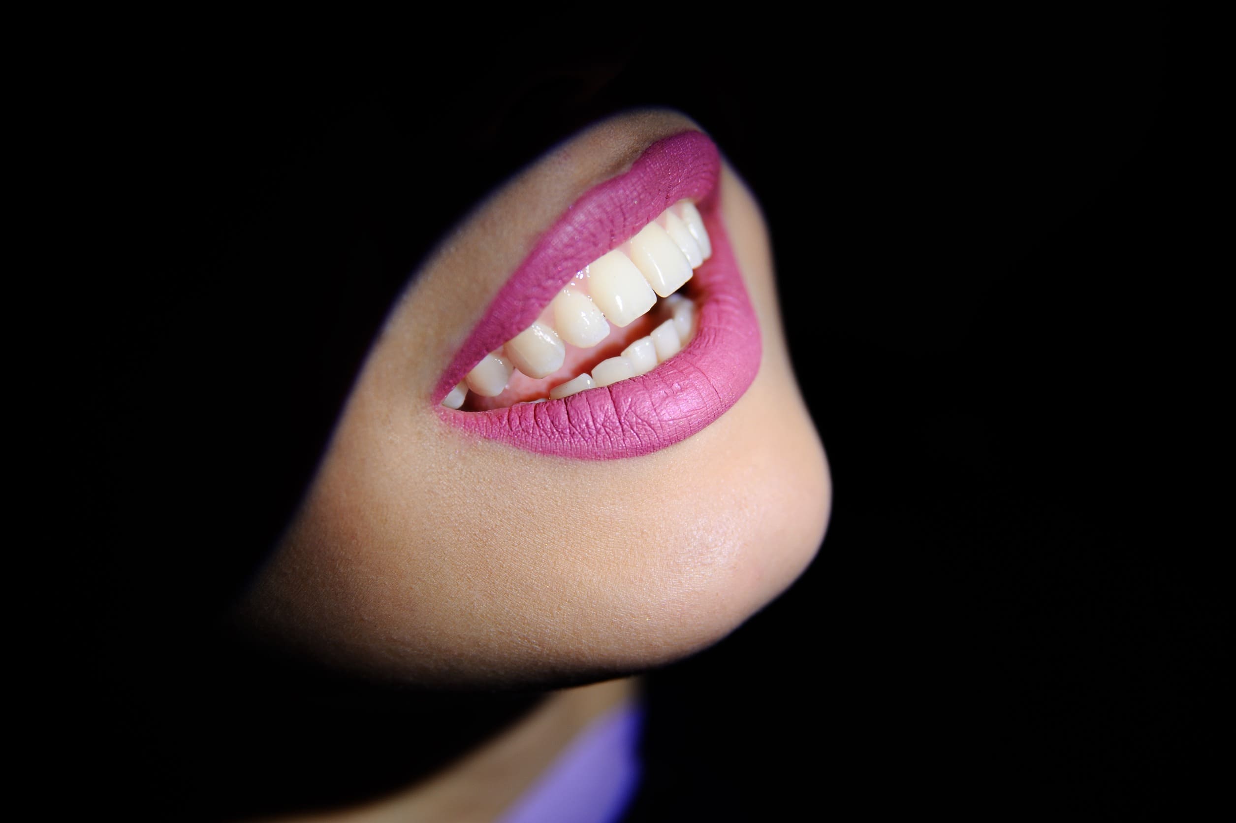 Smile makeover with veneers at Dentelli Split – cosmetic dentist in Split creating bright, natural-looking smiles